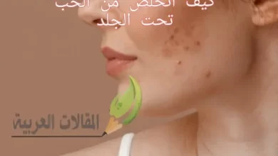 كيف اتخلص من الحب تحت الجلد