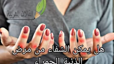 هل يمكن الشفاء من مرض الذئبة الحمراء