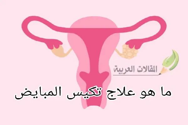 ما هو علاج تكيس المبايض