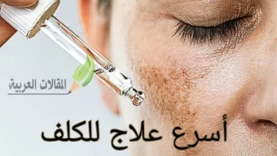 أسرع علاج للكلف