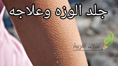 جلد الوزة وعلاجه