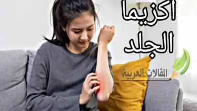 اكزيما الجلد