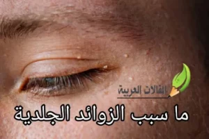 ما سبب الزوائد الجلدية