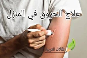 علاج الحروق في المنزل