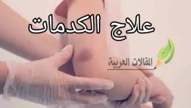 علاج الكدمات