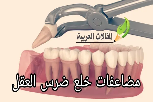 مضاعفات خلع ضرس العقل