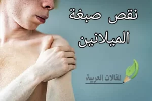 نقص صبغة الميلانين