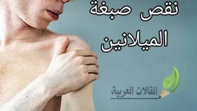 نقص صبغة الميلانين